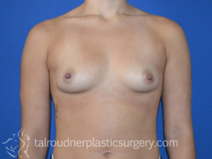 Breast Augmentation
