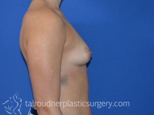 Breast Augmentation