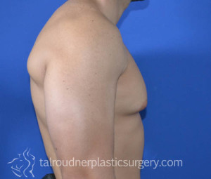 Male Breast Reduction (Gynecomastia)