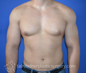 Male Breast Reduction (Gynecomastia)