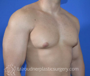 Male Breast Reduction (Gynecomastia)