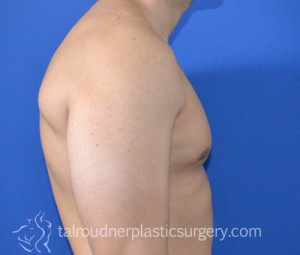 Male Breast Reduction (Gynecomastia)