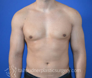 Male Breast Reduction (Gynecomastia)