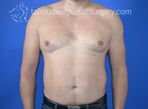 Male Breast Reduction (Gynecomastia)