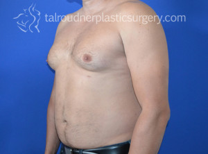 Male Breast Reduction (Gynecomastia)