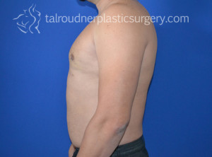 Male Breast Reduction (Gynecomastia)
