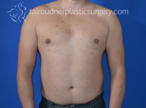 Male Breast Reduction (Gynecomastia)