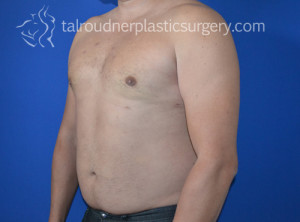 Male Breast Reduction (Gynecomastia)