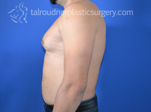 Male Breast Reduction (Gynecomastia)