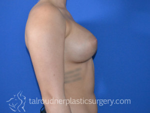 Breast Augmentation
