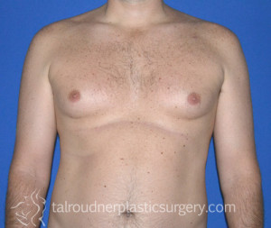 Male Breast Reduction (Gynecomastia)