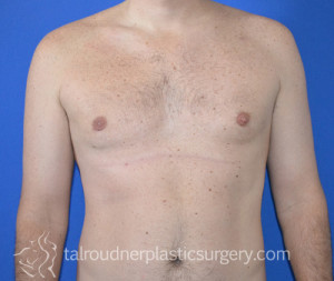 Male Breast Reduction (Gynecomastia)