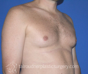 Male Breast Reduction (Gynecomastia)