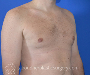 Male Breast Reduction (Gynecomastia)