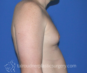 Male Breast Reduction (Gynecomastia)