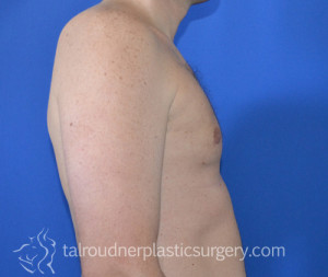 Male Breast Reduction (Gynecomastia)