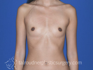 Breast Augmentation