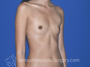 Breast Augmentation