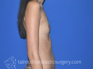Breast Augmentation