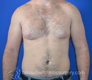 Male Breast Reduction (Gynecomastia)