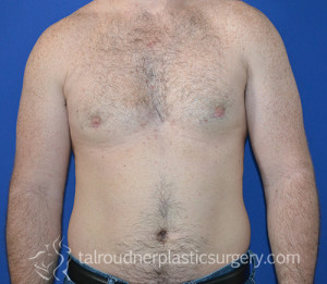 Male Breast Reduction (Gynecomastia)