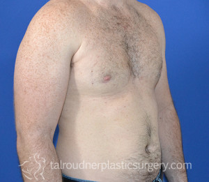 Male Breast Reduction (Gynecomastia)