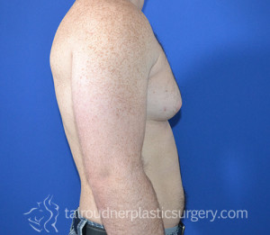 Male Breast Reduction (Gynecomastia)