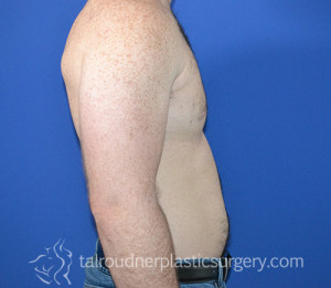 Male Breast Reduction (Gynecomastia)