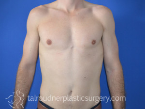 Male Breast Reduction (Gynecomastia)