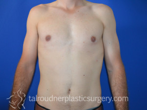 Male Breast Reduction (Gynecomastia)
