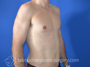 Male Breast Reduction (Gynecomastia)