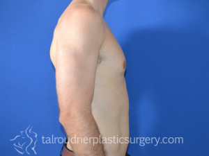Male Breast Reduction (Gynecomastia)