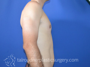 Male Breast Reduction (Gynecomastia)