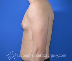 Male Breast Reduction (Gynecomastia)