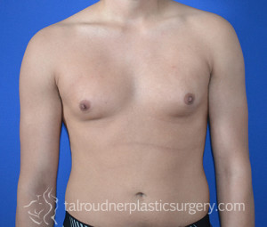 Male Breast Reduction (Gynecomastia)