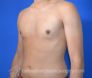 Male Breast Reduction (Gynecomastia)
