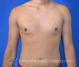 Male Breast Reduction (Gynecomastia)