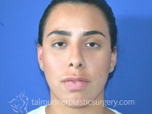 Nose Surgery (Rhinoplasty)