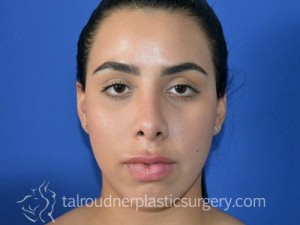 Nose Surgery (Rhinoplasty)