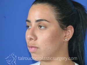 Nose Surgery (Rhinoplasty)
