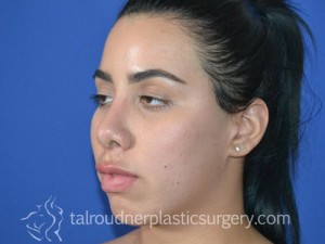 Nose Surgery (Rhinoplasty)