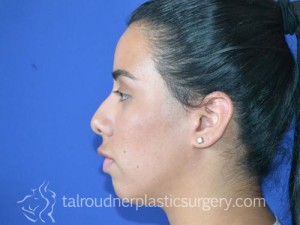 Nose Surgery (Rhinoplasty)