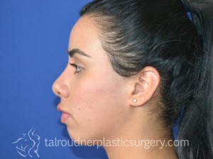 Nose Surgery (Rhinoplasty)