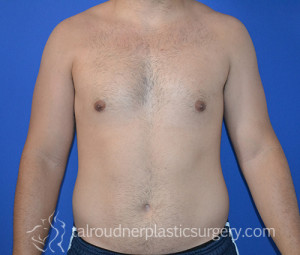 Male Breast Reduction (Gynecomastia)