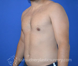 Male Breast Reduction (Gynecomastia)