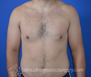 Male Breast Reduction (Gynecomastia)