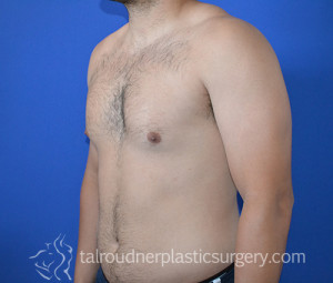 Male Breast Reduction (Gynecomastia)