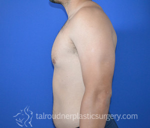 Male Breast Reduction (Gynecomastia)