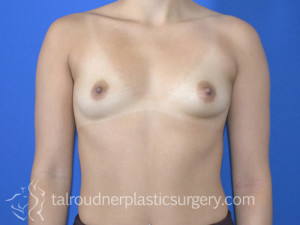 Breast Augmentation