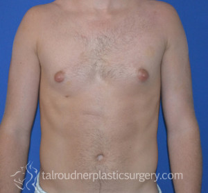 Male Breast Reduction (Gynecomastia)